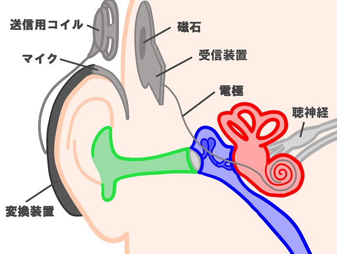 イラストで解説 人工内耳とは 仕組みと手術方法とかかる費用について Oh みみなび